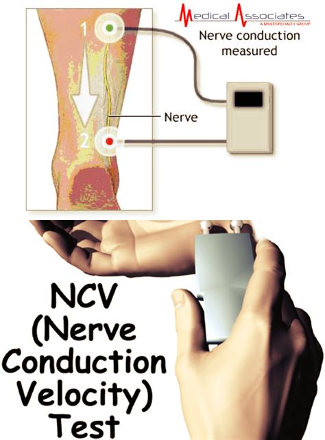 testing nerve conduction velocioty for drop foot|neurogenic foot drop images.